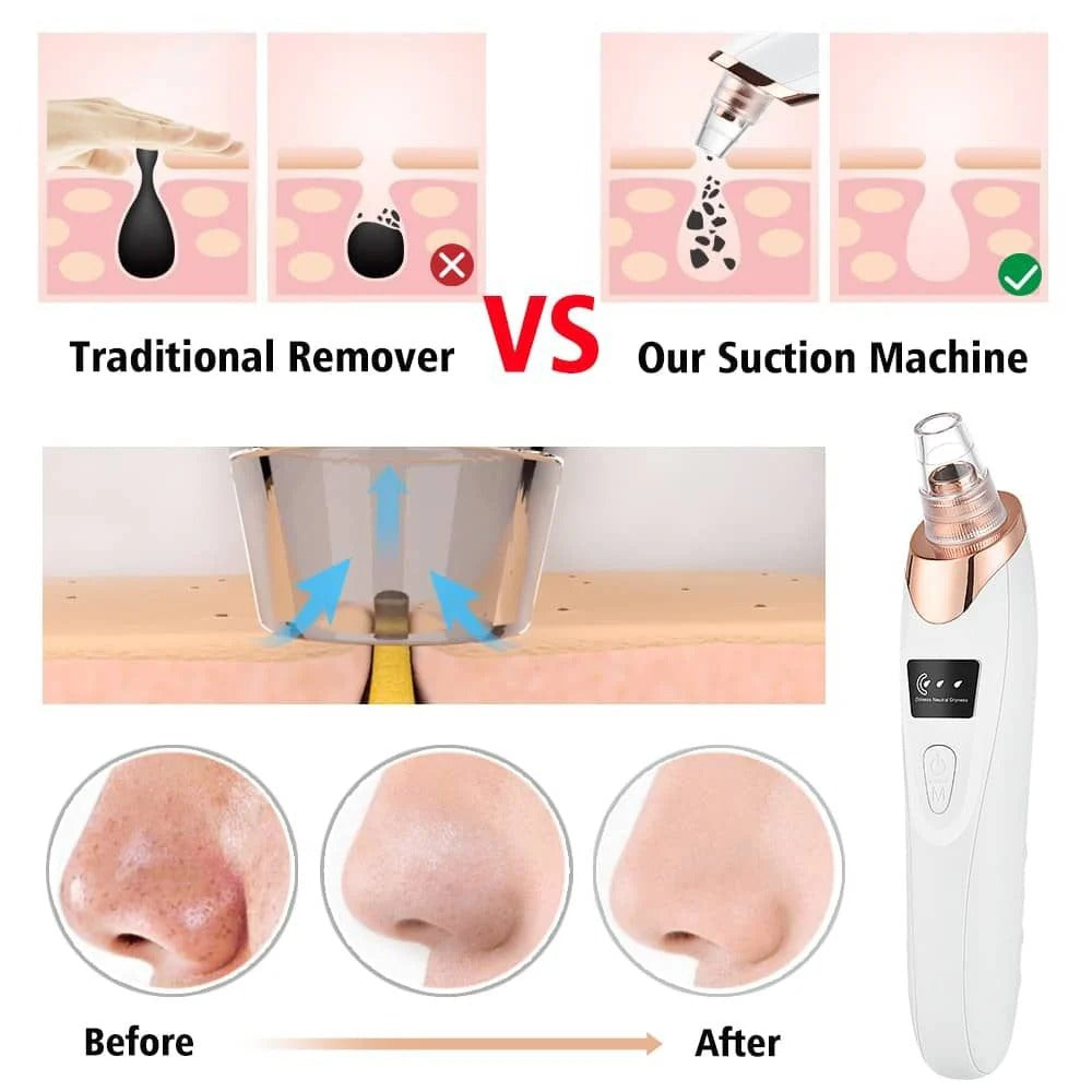 Electric Blackhead Remover | Vacuum Acne & Pore Cleaner | 5 Heads Suction Machine
